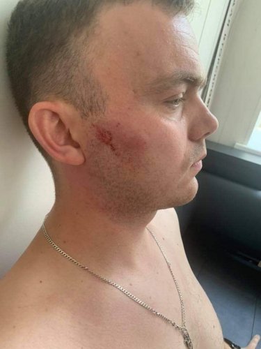 Напавшего на одесского активиста, который борется с застройщиками склонов, задержали