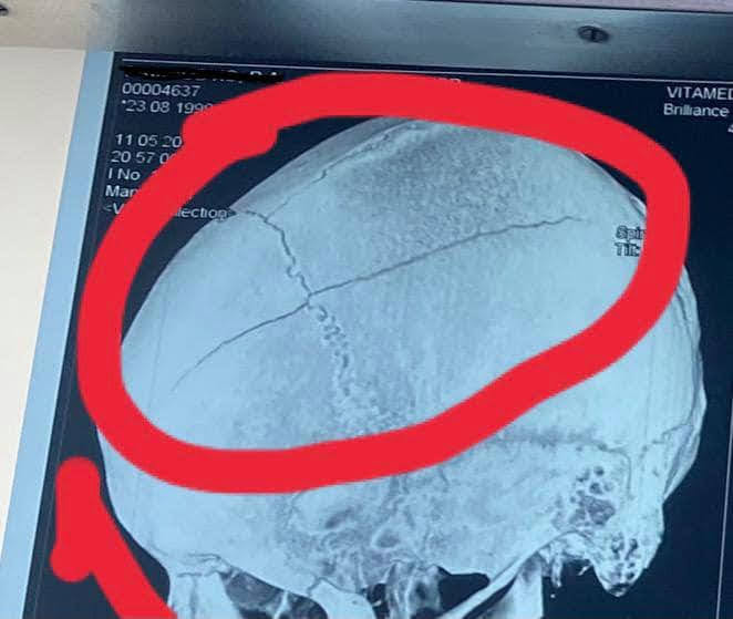 Одессит на электросамокате получил перелом черепа (видео)