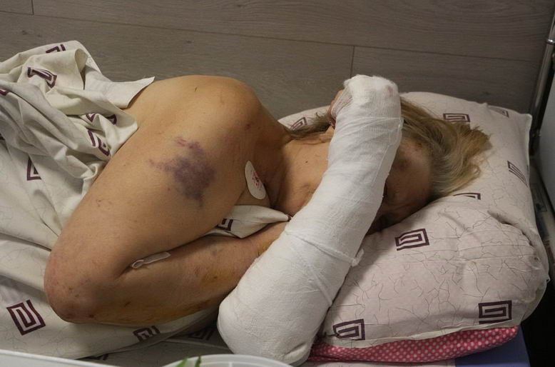 Одессит получил тяжелое ранение во время российской ракетной атаки